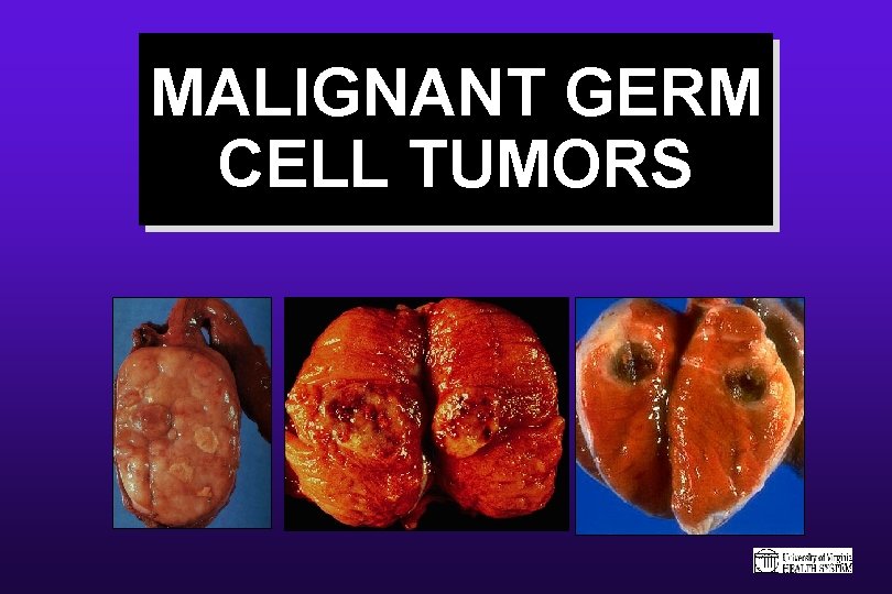 MALIGNANT GERM CELL TUMORS 
