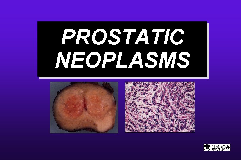 PROSTATIC NEOPLASMS 