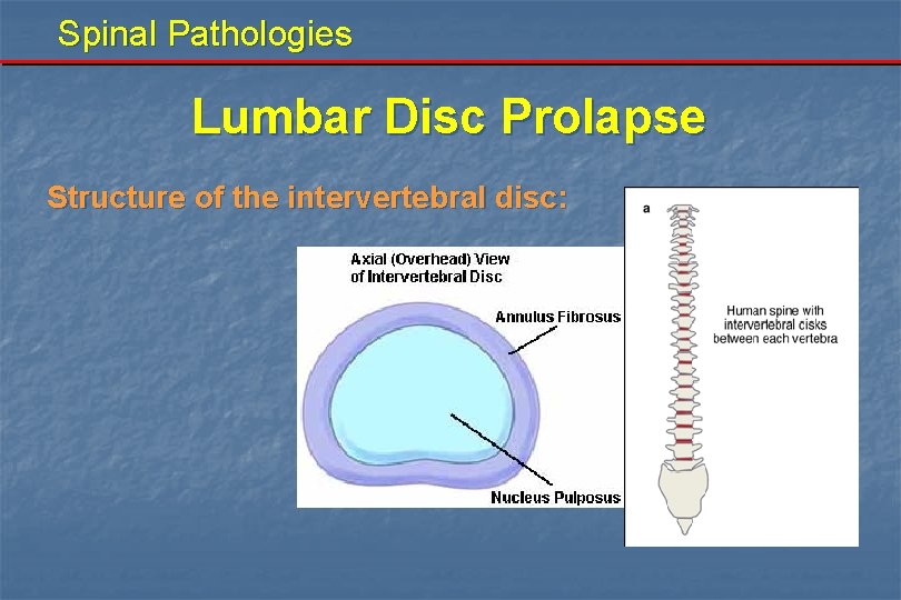 Spinal Pathologies Lumbar Disc Prolapse Structure of the intervertebral disc: 