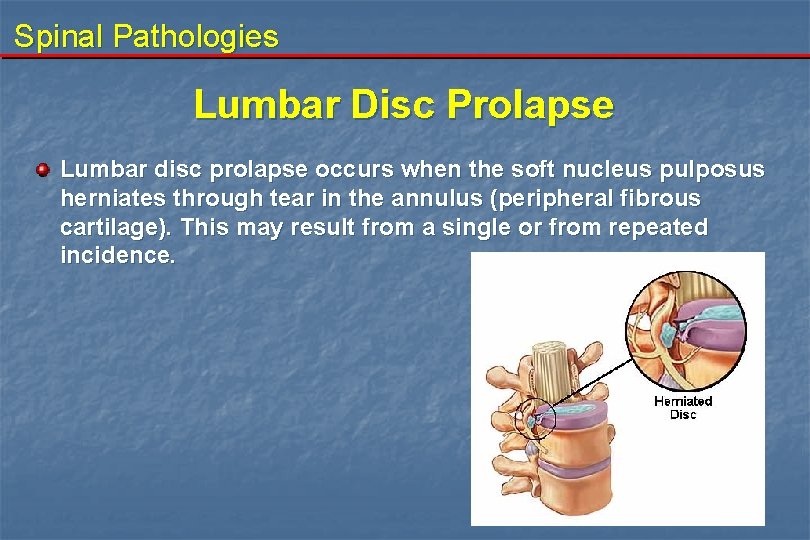 Spinal Pathologies Lumbar Disc Prolapse Lumbar disc prolapse occurs when the soft nucleus pulposus