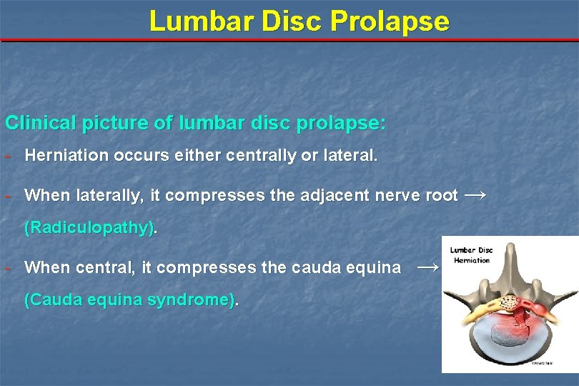 Lumbar Disc Prolapse Clinical picture of lumbar disc prolapse: - Herniation occurs either centrally