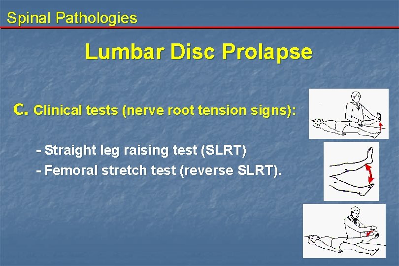 Spinal Pathologies Lumbar Disc Prolapse C. Clinical tests (nerve root tension signs): - Straight