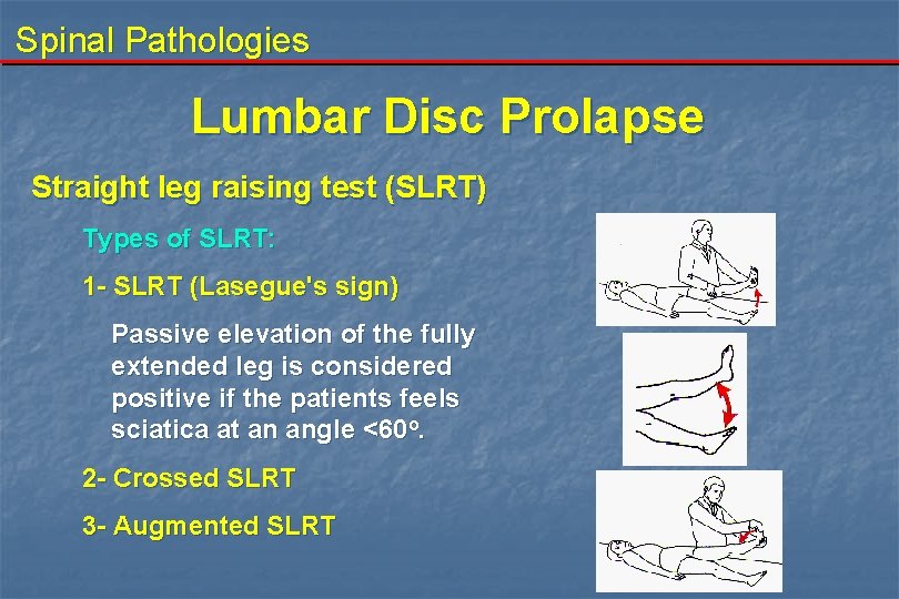 Spinal Pathologies Lumbar Disc Prolapse Straight leg raising test (SLRT) Types of SLRT: 1
