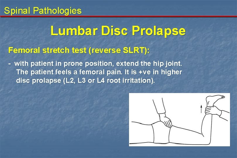 Spinal Pathologies Lumbar Disc Prolapse Femoral stretch test (reverse SLRT): - with patient in