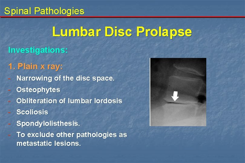 Spinal Pathologies Lumbar Disc Prolapse Investigations: 1. Plain x ray: - Narrowing of the