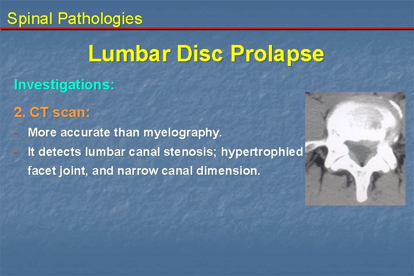 Spinal Pathologies Lumbar Disc Prolapse Investigations: 2. CT scan: - More accurate than myelography.