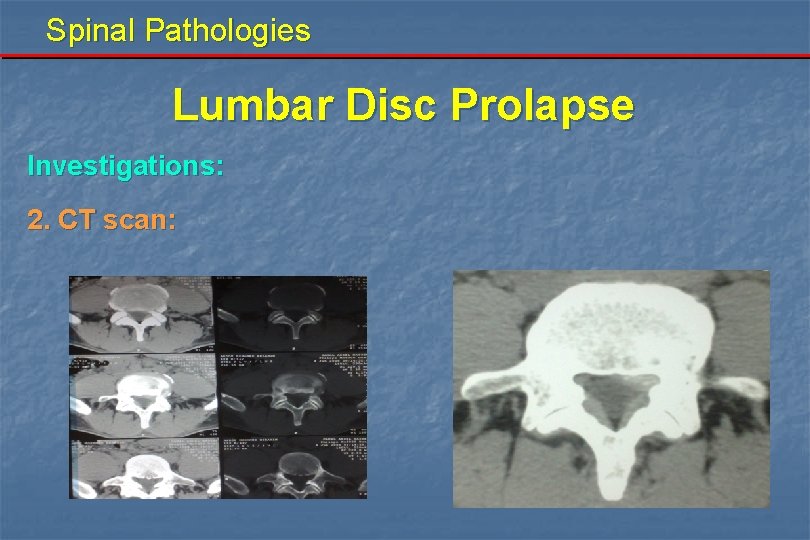 Spinal Pathologies Lumbar Disc Prolapse Investigations: 2. CT scan: 
