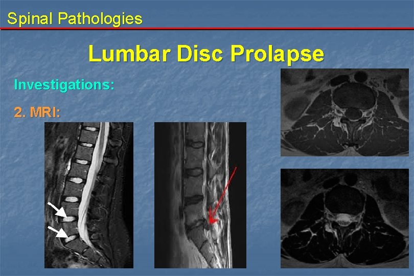 Spinal Pathologies Lumbar Disc Prolapse Investigations: 2. MRI: 