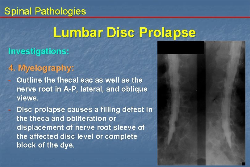 Spinal Pathologies Lumbar Disc Prolapse Investigations: 4. Myelography: - Outline thecal sac as well