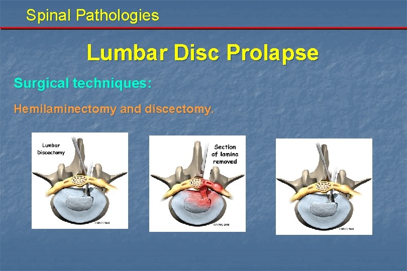 Spinal Pathologies Lumbar Disc Prolapse Surgical techniques: Hemilaminectomy and discectomy. 