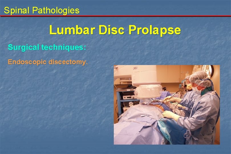 Spinal Pathologies Lumbar Disc Prolapse Surgical techniques: Endoscopic discectomy. 