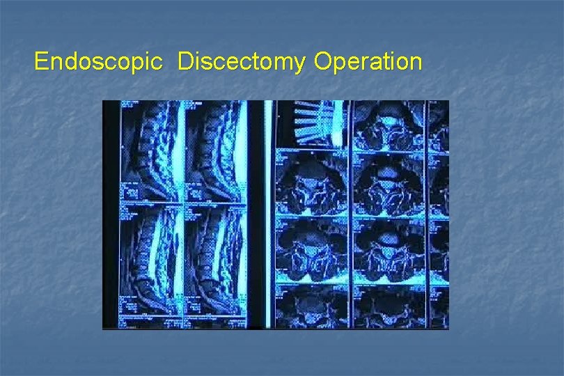 Endoscopic Discectomy Operation 