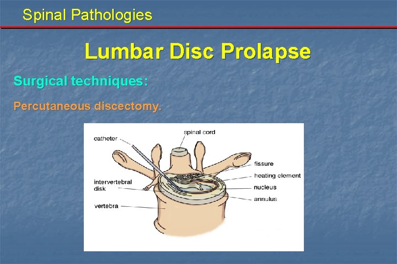 Spinal Pathologies Lumbar Disc Prolapse Surgical techniques: Percutaneous discectomy. 