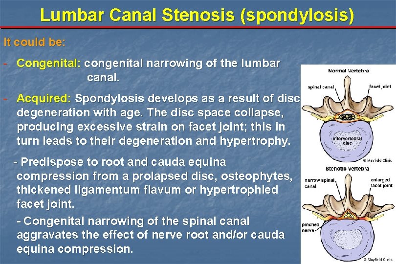 Lumbar Canal Stenosis (spondylosis) It could be: - Congenital: congenital narrowing of the lumbar