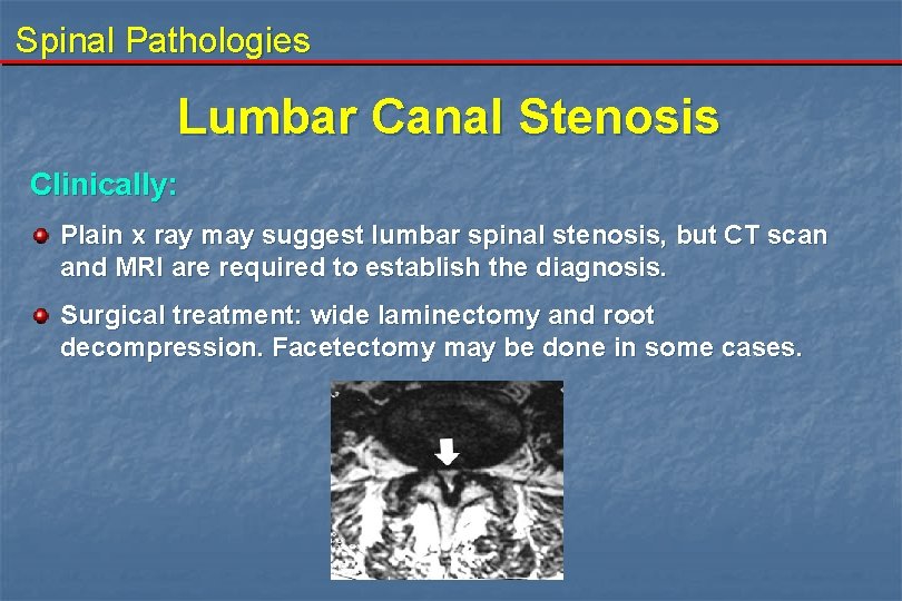 Spinal Pathologies Lumbar Canal Stenosis Clinically: Plain x ray may suggest lumbar spinal stenosis,