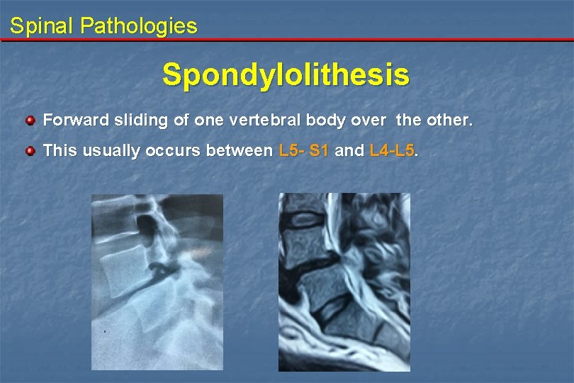 Spinal Pathologies Spondylolithesis Forward sliding of one vertebral body over the other. This usually