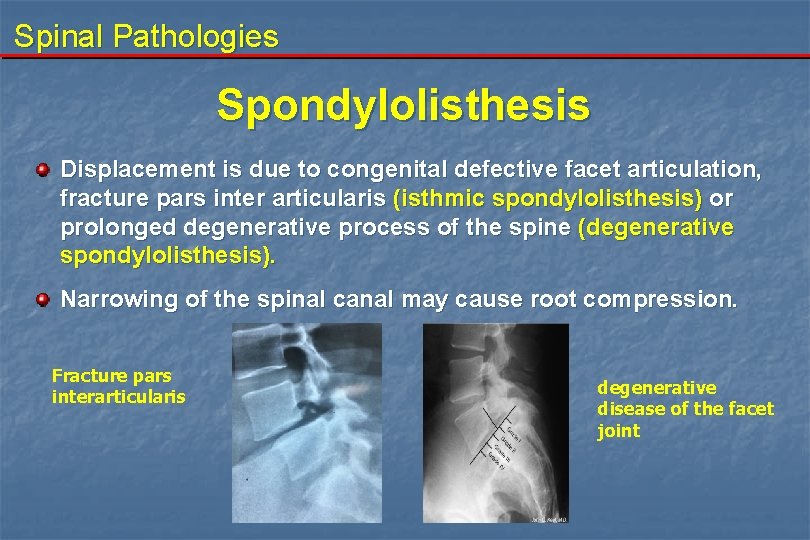 Spinal Pathologies Spondylolisthesis Displacement is due to congenital defective facet articulation, fracture pars inter