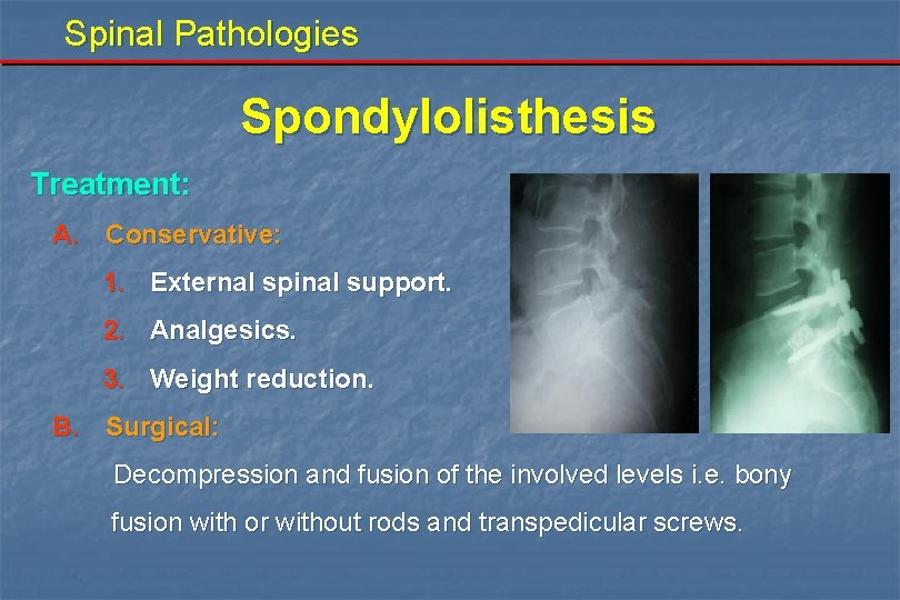 Spinal Pathologies Spondylolisthesis Treatment: A. Conservative: 1. External spinal support. 2. Analgesics. 3. Weight