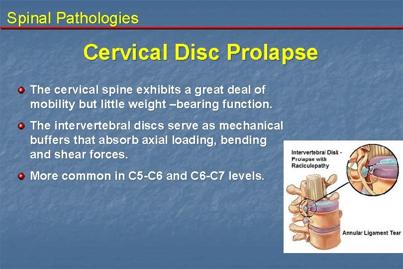 Spinal Pathologies Cervical Disc Prolapse The cervical spine exhibits a great deal of mobility