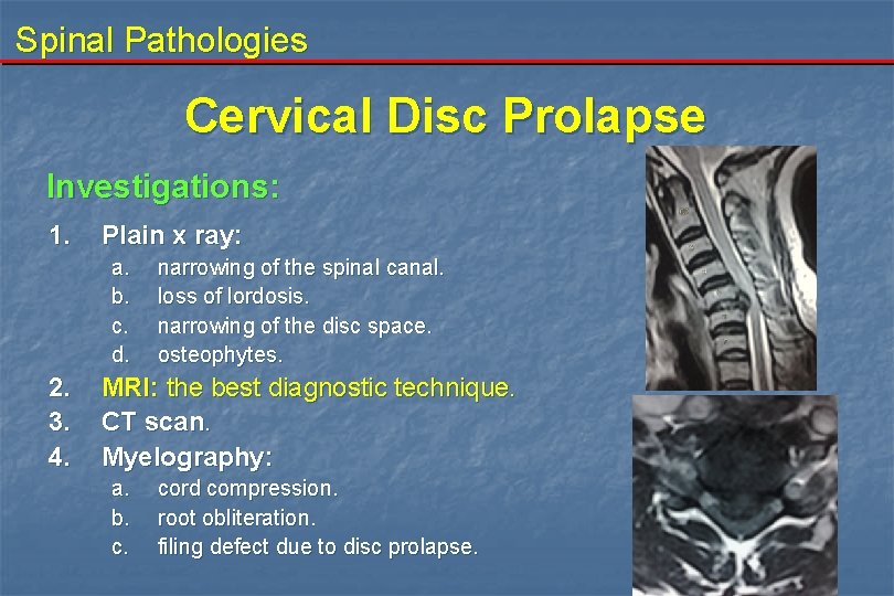 Spinal Pathologies Cervical Disc Prolapse Investigations: 1. Plain x ray: a. b. c. d.