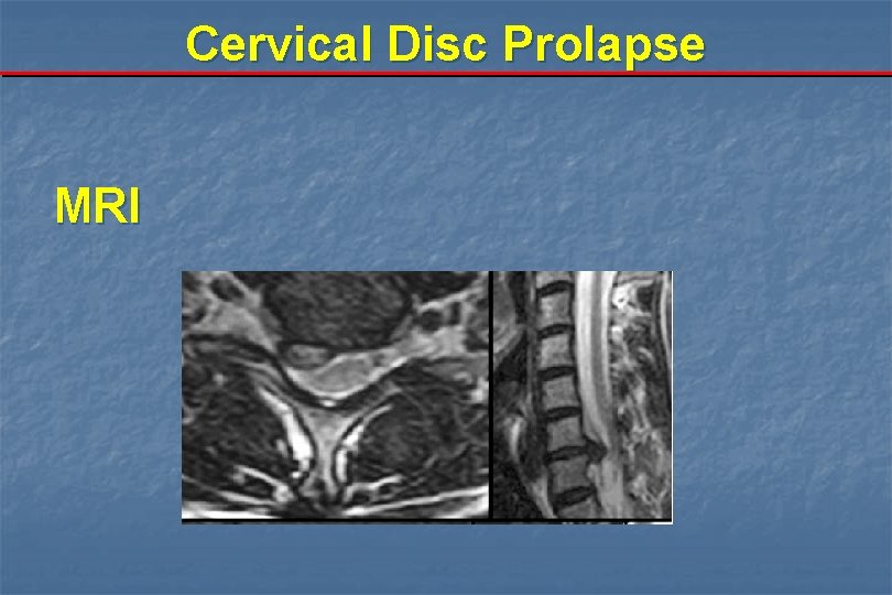 Cervical Disc Prolapse MRI 