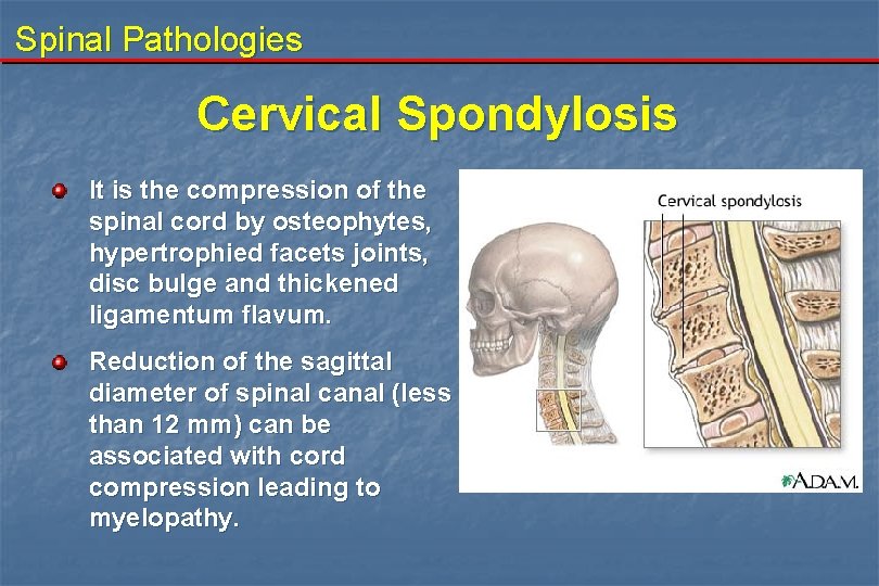 Spinal Pathologies Cervical Spondylosis It is the compression of the spinal cord by osteophytes,