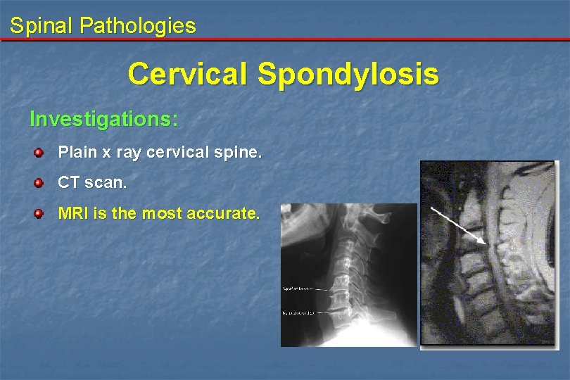 Spinal Pathologies Cervical Spondylosis Investigations: Plain x ray cervical spine. CT scan. MRI is