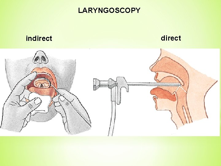 LARYNGOSCOPY indirect 