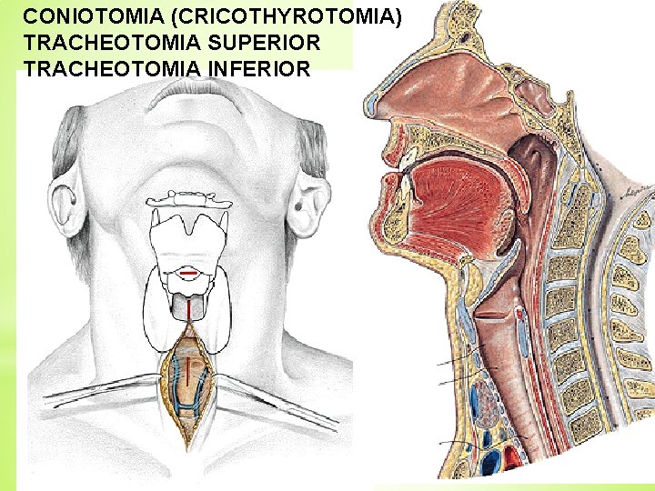 CONIOTOMIA (CRICOTHYROTOMIA) TRACHEOTOMIA SUPERIOR TRACHEOTOMIA INFERIOR 