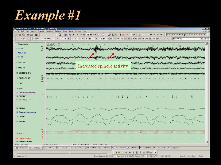 Example #1 Increased spindle activity 