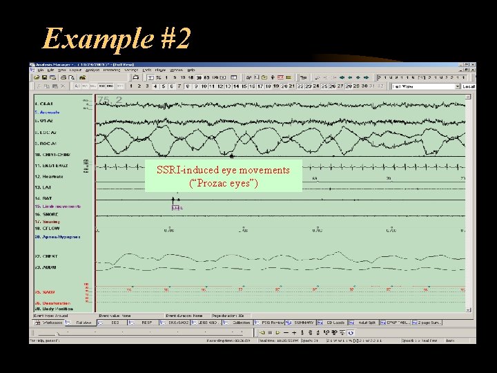 Example #2 SSRI-induced eye movements (“Prozac eyes”) 