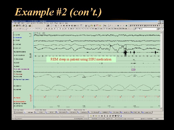Example #2 (con’t. ) REM sleep in patient using SSRI medication 