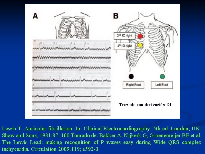 Trazado con derivación DI Lewis T. Auricular fibrillation. In: Clinical Electrocardiography. 5 th ed.