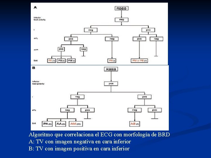 Algoritmo que correlaciona el ECG con morfología de BRD A: TV con imagen negativa