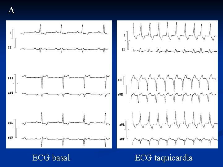 A ECG basal ECG taquicardia 