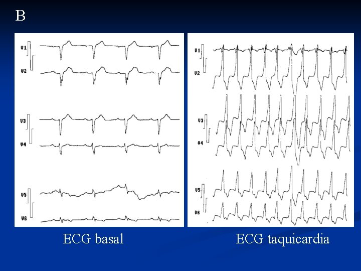 B ECG basal ECG taquicardia 