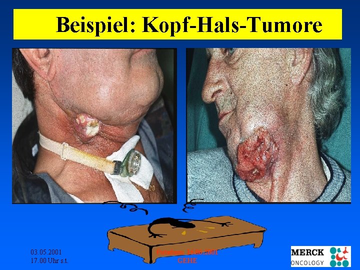 Beispiel: Kopf-Hals-Tumore 03. 05. 2001 17. 00 Uhr s. t. Potsdam: 16. 06. 2001