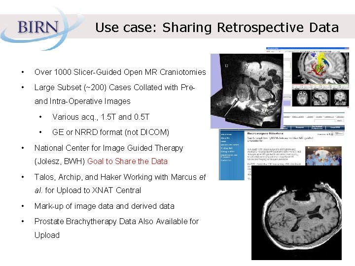 Use case: Sharing Retrospective Data • Over 1000 Slicer-Guided Open MR Craniotomies • Large