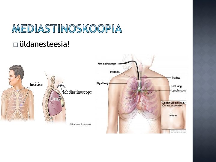 � üldanesteesia! 