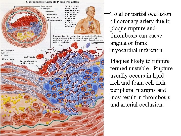 Total or partial occlusion of coronary artery due to plaque rupture and thrombosis can