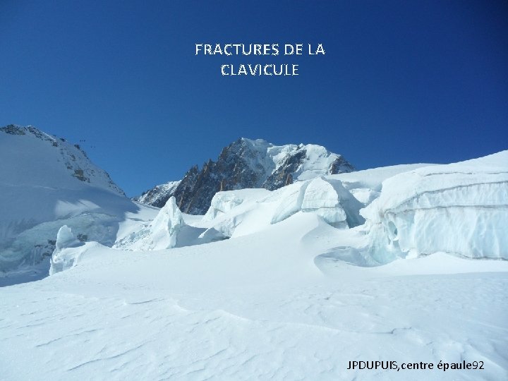 FRACTURES DE LA CLAVICULE LES FRACTURES DE LA CLAVICULE JPDUPUIS, centre épaule 92 