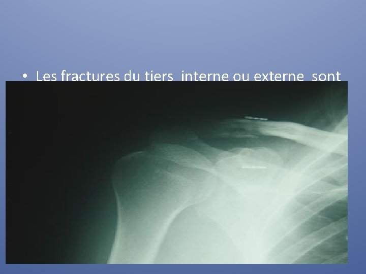  • Les fractures du tiers interne ou externe sont rarement déplacées 