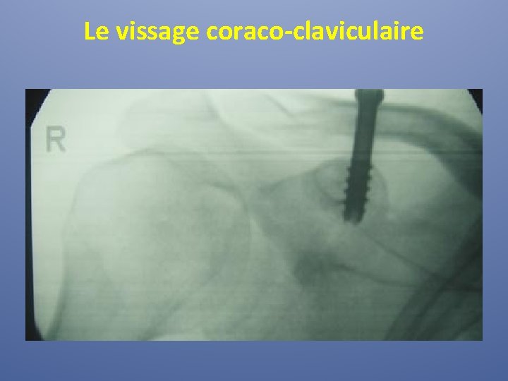 Le vissage coraco-claviculaire 