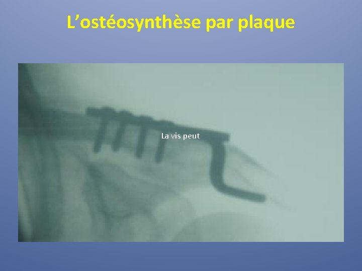 L’ostéosynthèse par plaque La vis peut 