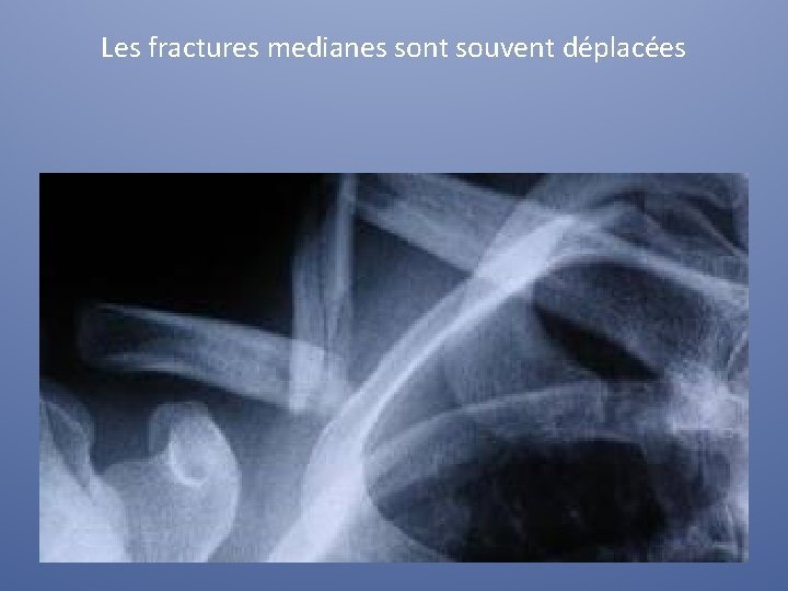 Les fractures medianes sont souvent déplacées 