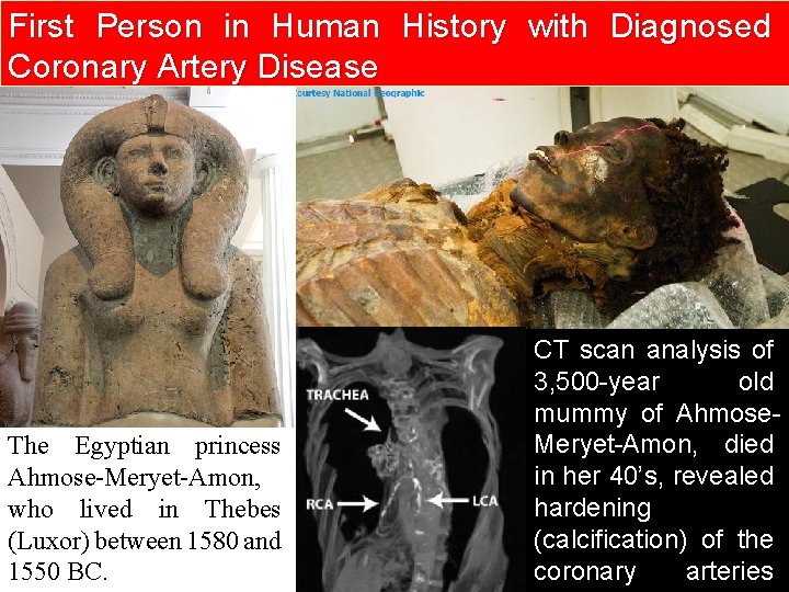 First Person in Human History with Diagnosed Coronary Artery Disease The Egyptian princess Ahmose-Meryet-Amon,