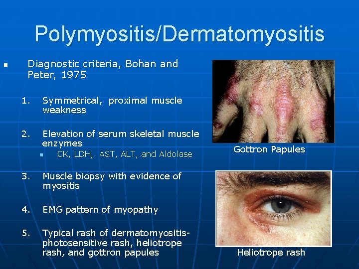 Polymyositis/Dermatomyositis n Diagnostic criteria, Bohan and Peter, 1975 1. Symmetrical, proximal muscle weakness 2.