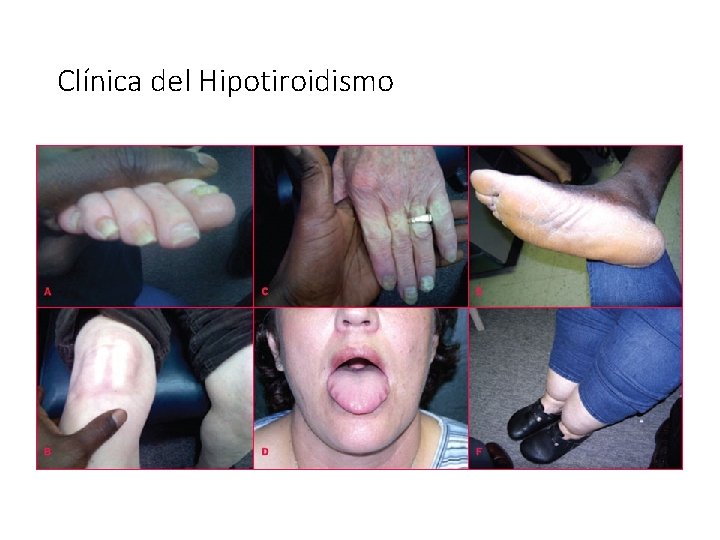Clínica del Hipotiroidismo 