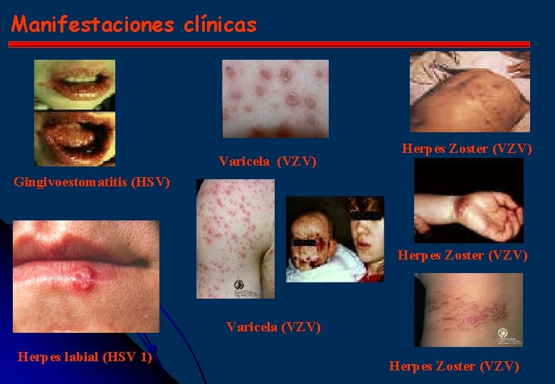 Manifestaciones clínicas Varicela (VZV) Herpes Zoster (VZV) Gingivoestomatitis (HSV) Herpes Zoster (VZV) Varicela (VZV)