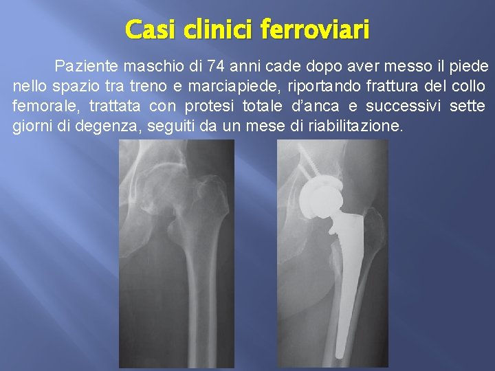 Casi clinici ferroviari Paziente maschio di 74 anni cade dopo aver messo il piede